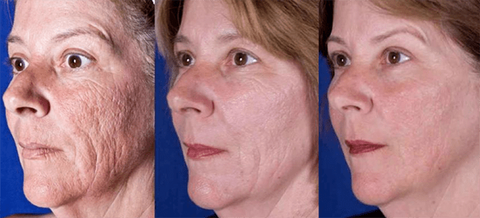Resultat no Laser Gesichts Hautverjüngung Prozedur